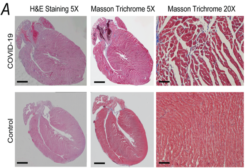 How COVID-19 Can Impact the Heart