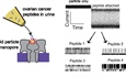 New Method Could Detect Early Ovarian Cancer from Urine Samples